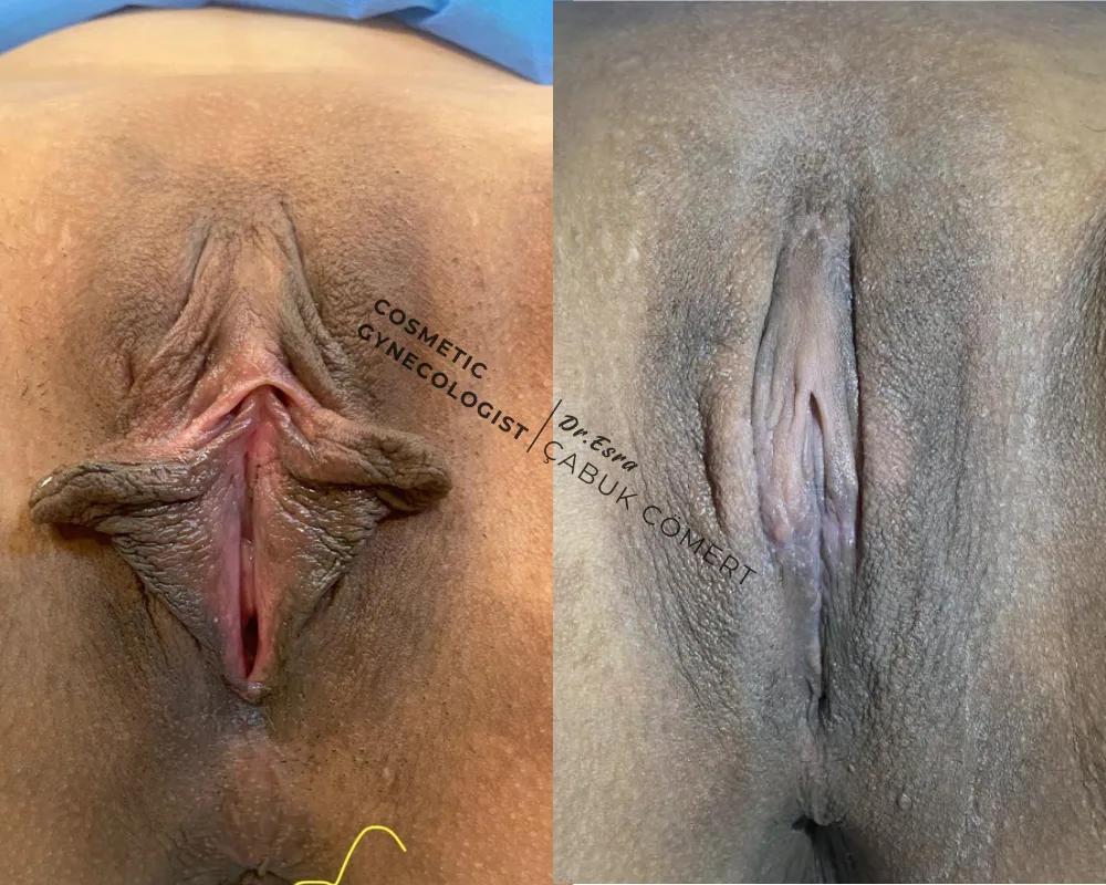 Labiaplasty - OP.DR.ESRA ÇABUK COMERT - Istanbul - Turkey 1