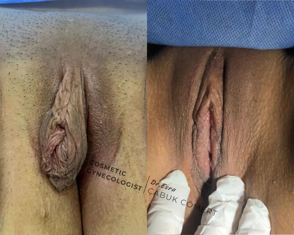 Labiaplasty - OP.DR.ESRA ÇABUK COMERT - Istanbul - Turkey 2