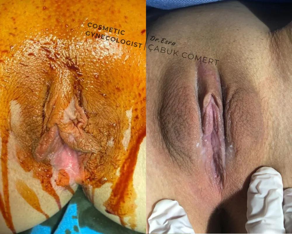 Labiaplasty - OP.DR.ESRA ÇABUK COMERT - Istanbul - Turkey 3