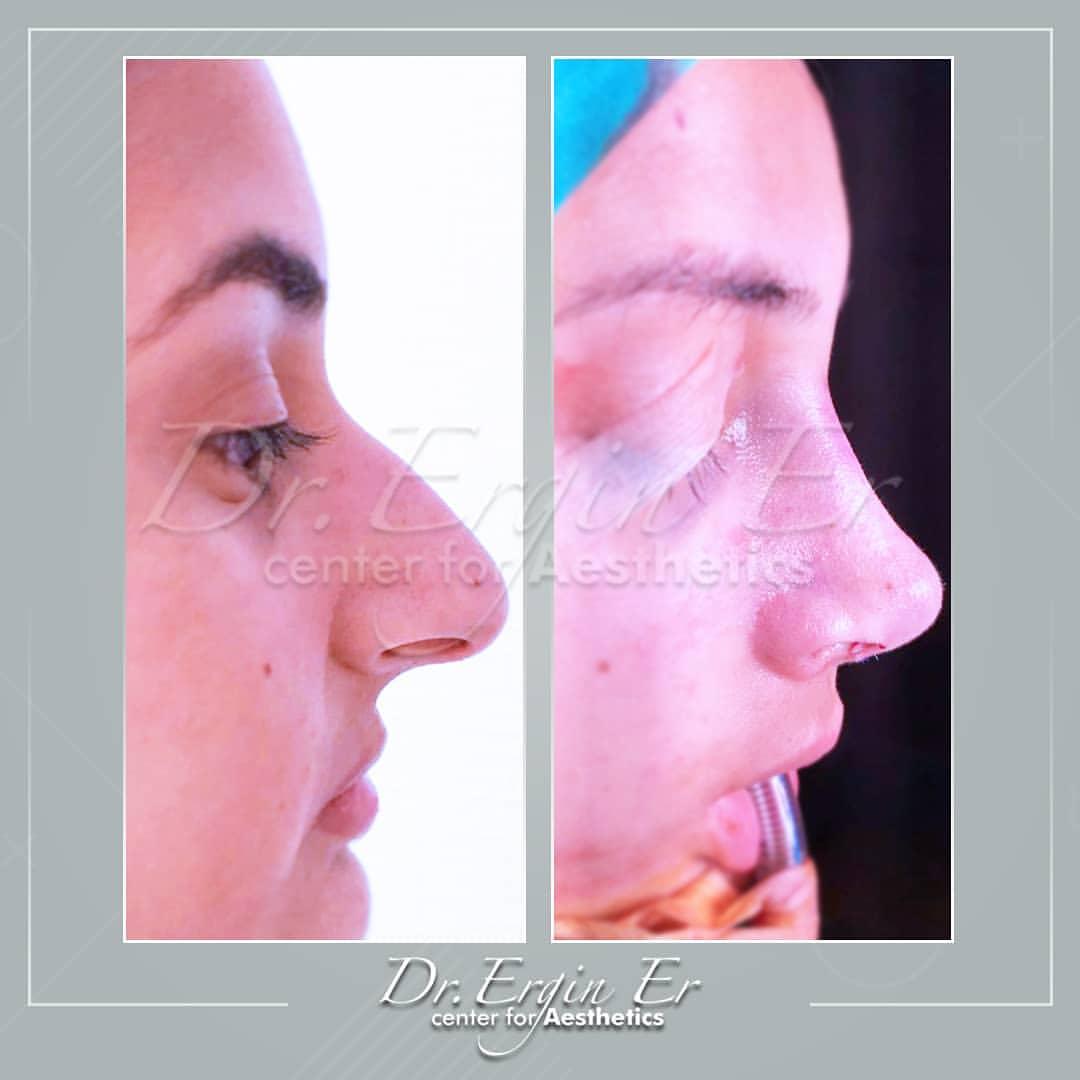 Rhinoplastie by Dr Ergin Er