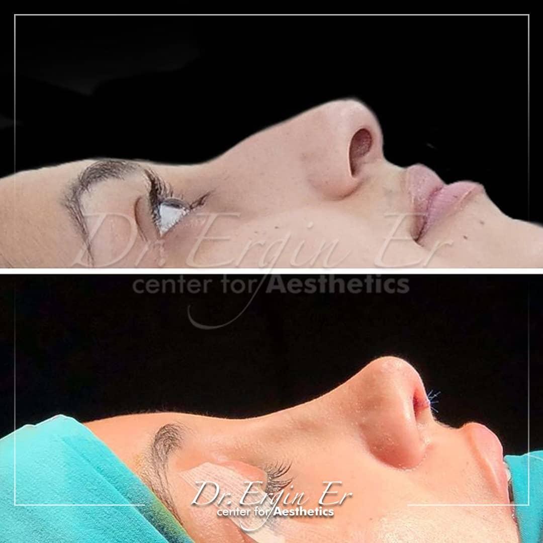 Rhinoplastie by Dr Ergin Er