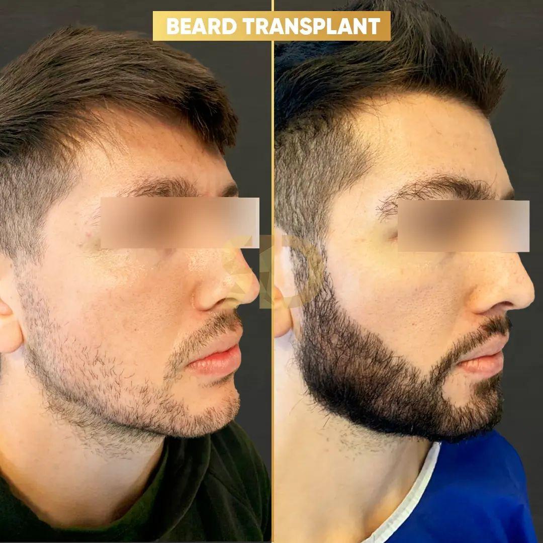 Beard Transplant by Esthetic Planet Team