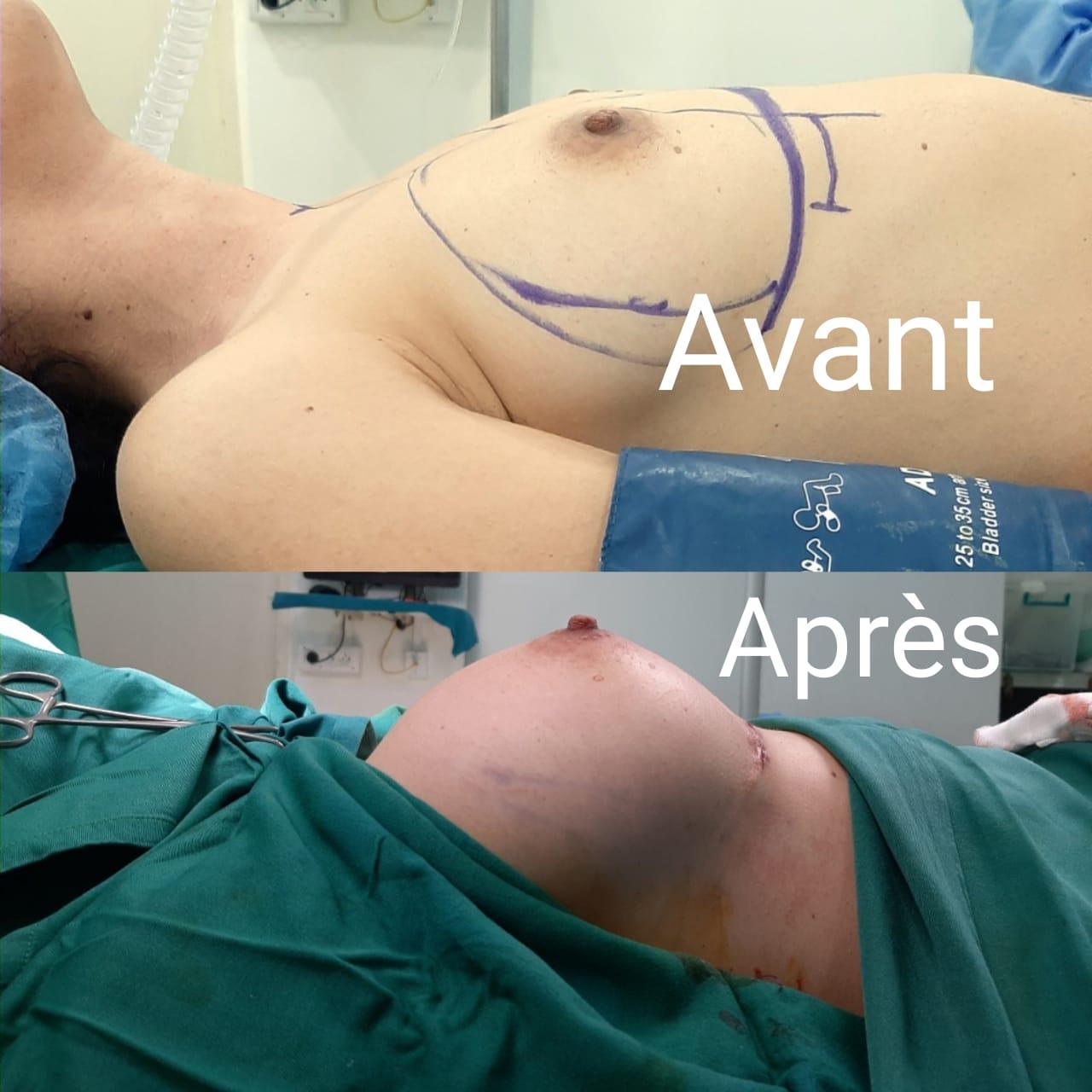 Zaghouan surgery results1