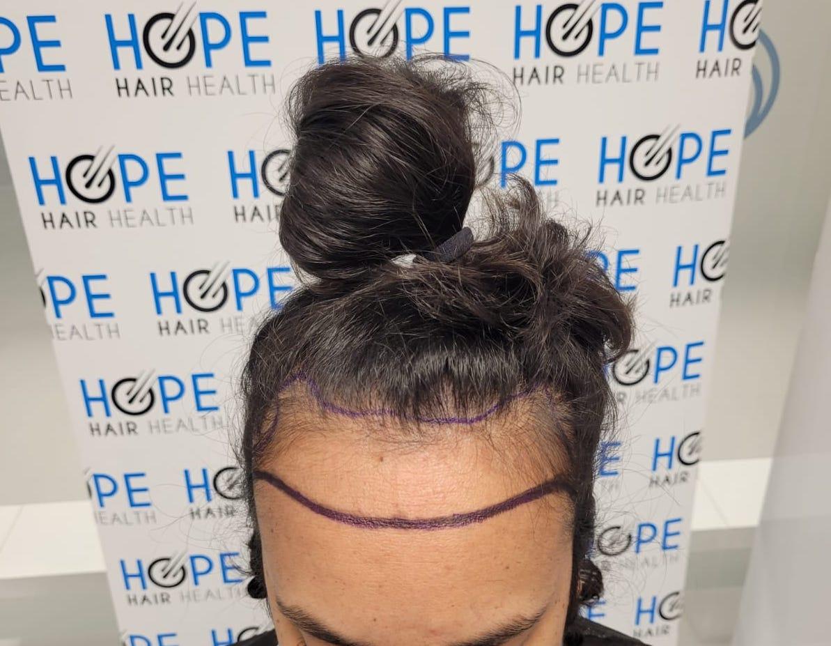 FUE feminine Istanbul turkey