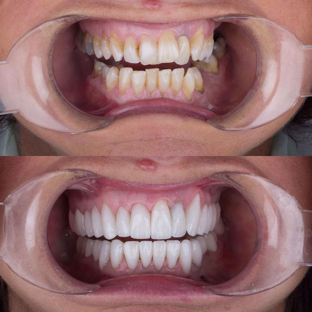 Veneers by Dentaglobal