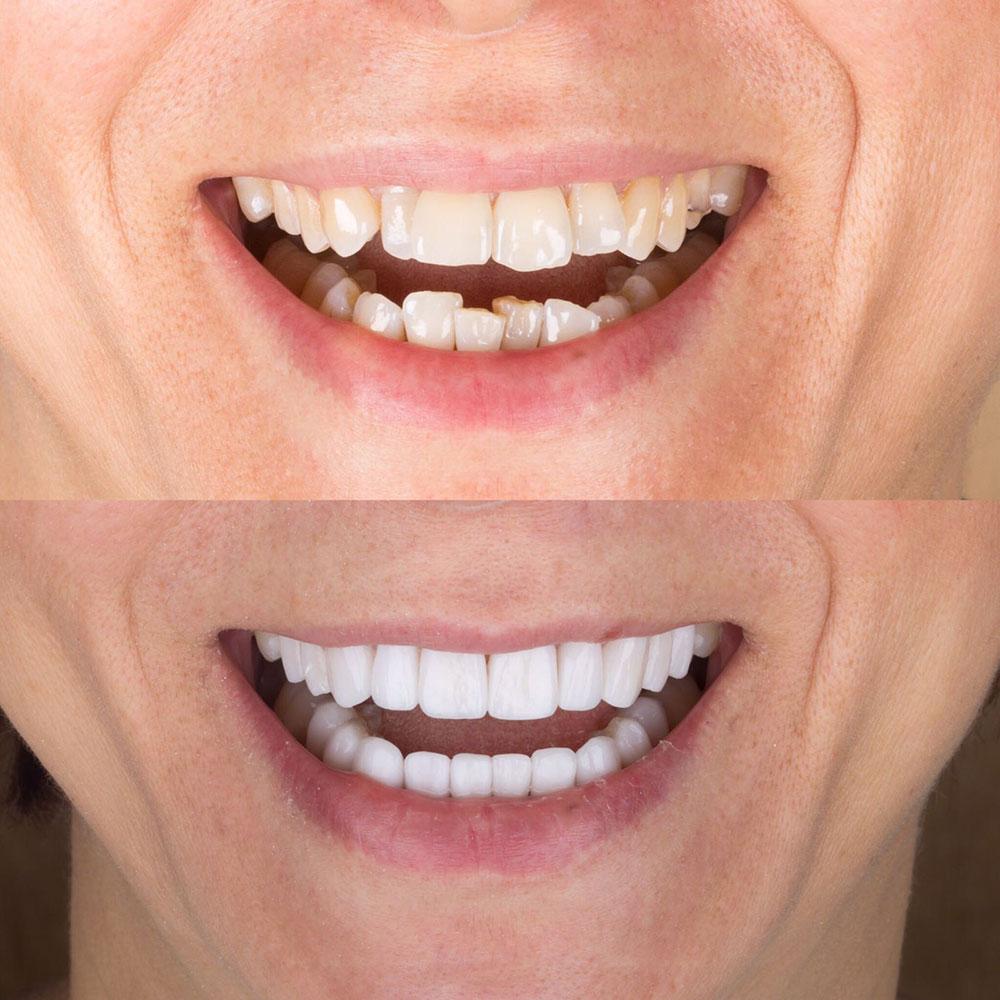 Veneers by Dentaglobal