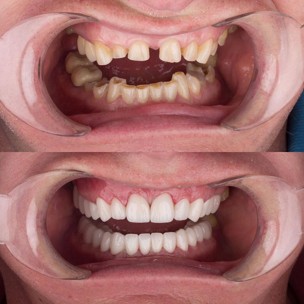 Crowns by Dentaglobal