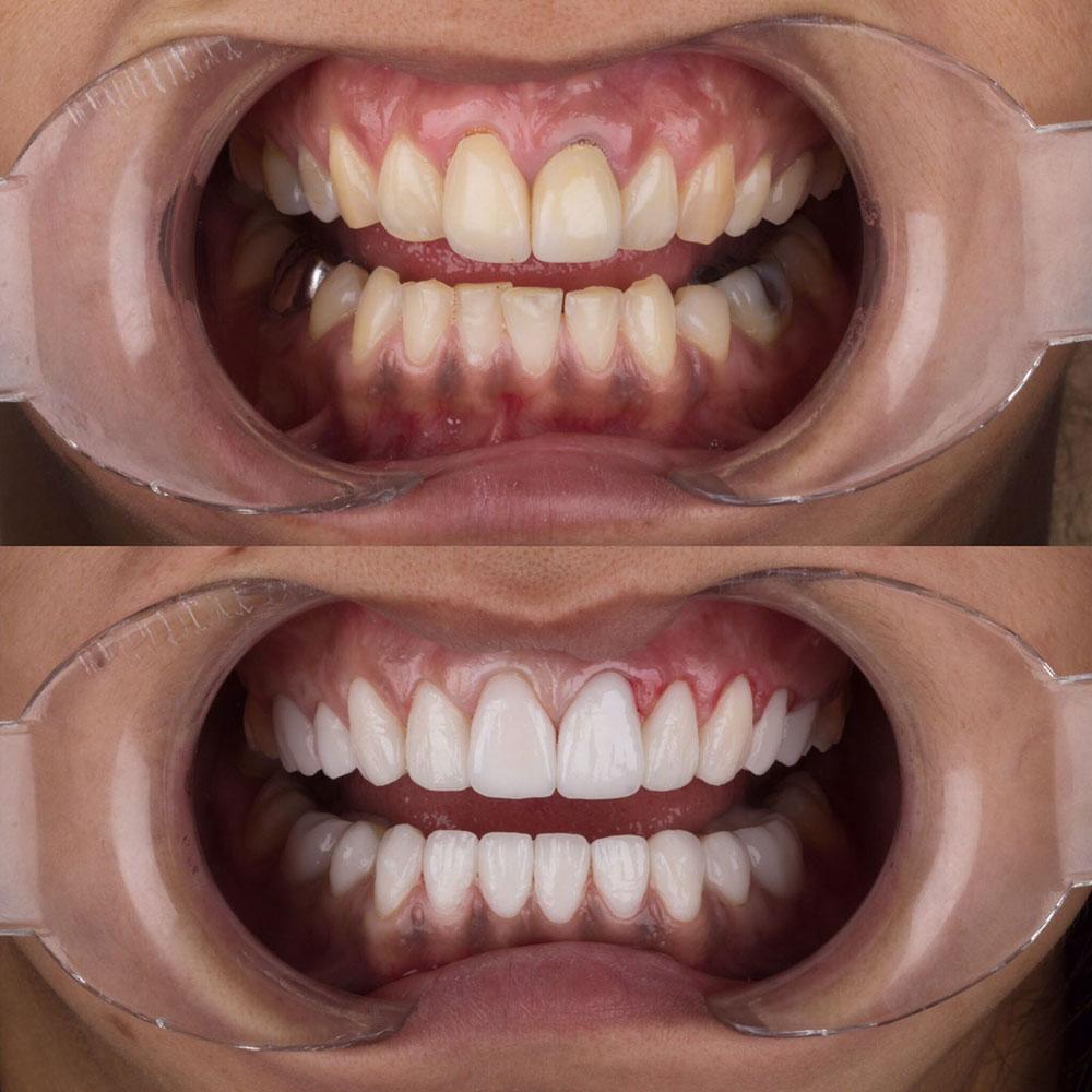 Veneers by Dentaglobal