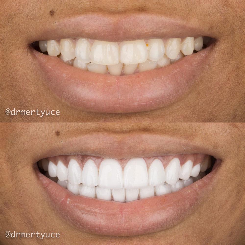 Veneers by Dentaglobal