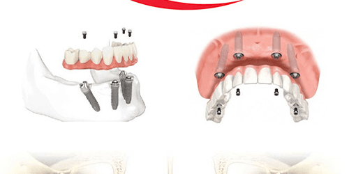 Total jaw reconstruction