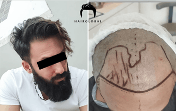 FUE