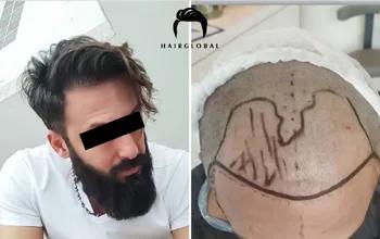 FUE