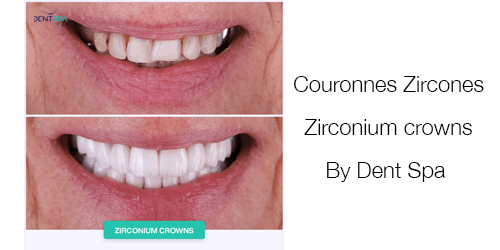 Zirconium crowns