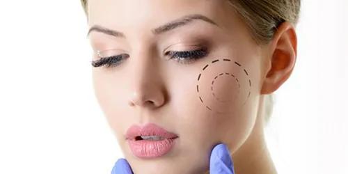 Lipofilling facciale