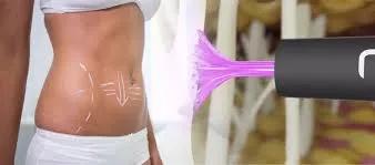 J Plasma Renuvion