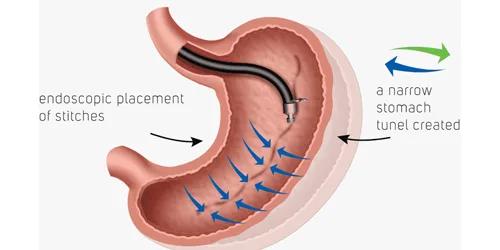 Endo sleeve (plicature)