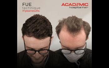 FUE