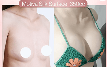 Breast augmentation Round implants