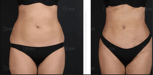 Hi-Def Lipo Six pack surgery