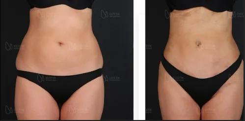 Hi-Def Lipo