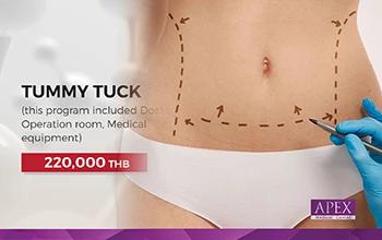 Tummy tuck