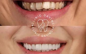Dental Veneers