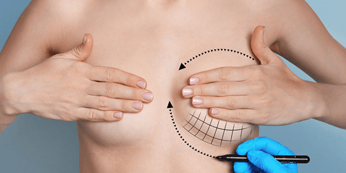 Lifting del seno con impianti