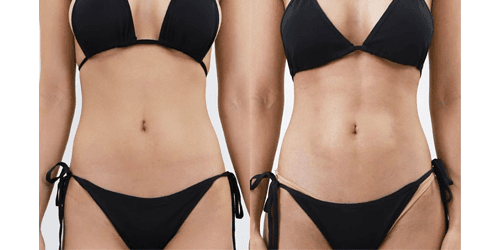 Hi-Def Lipo Six pack surgery
