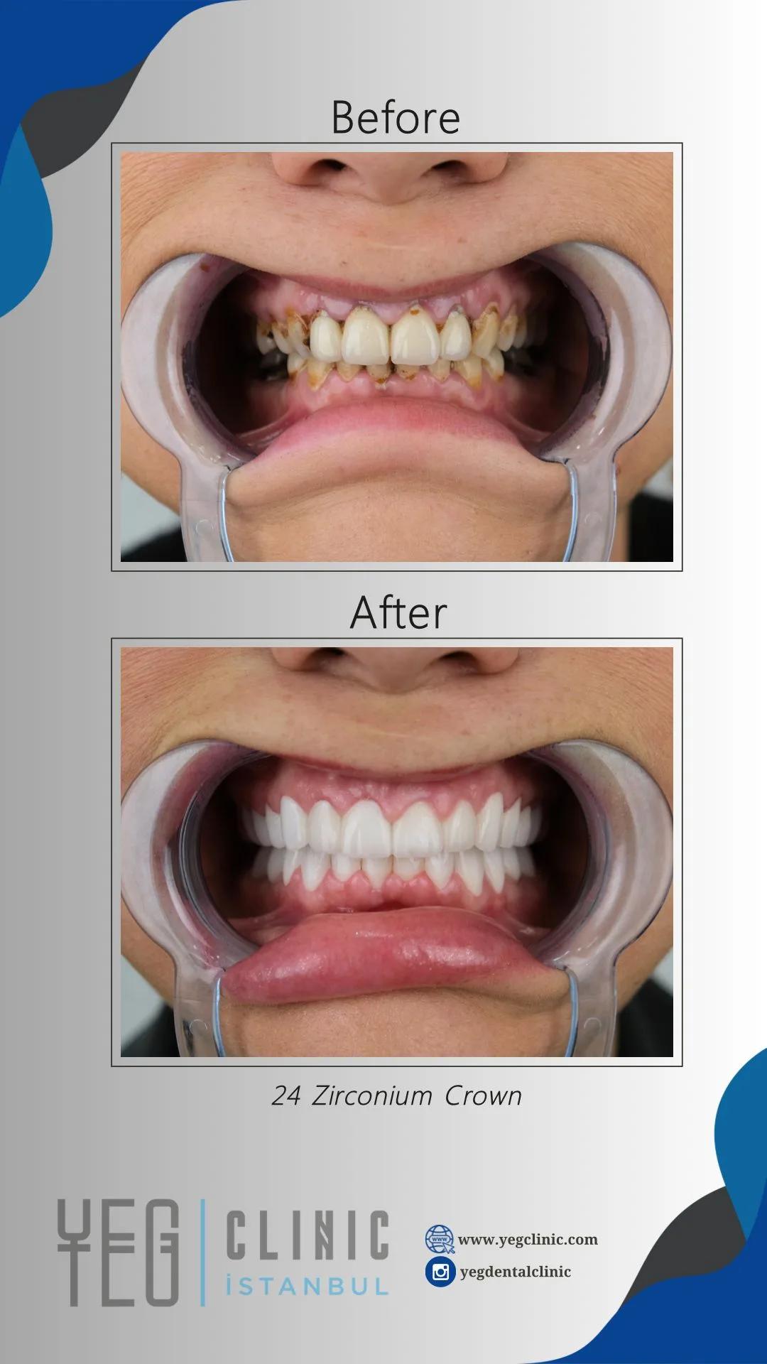 Dental crowns
