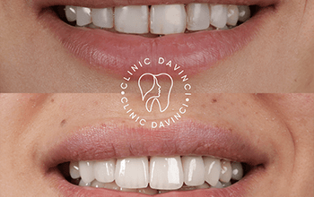 Emax Veneers