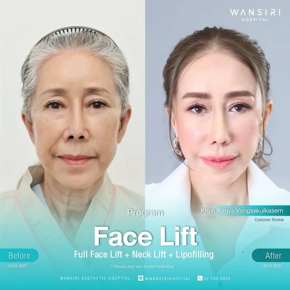 Lifting viso SMAS