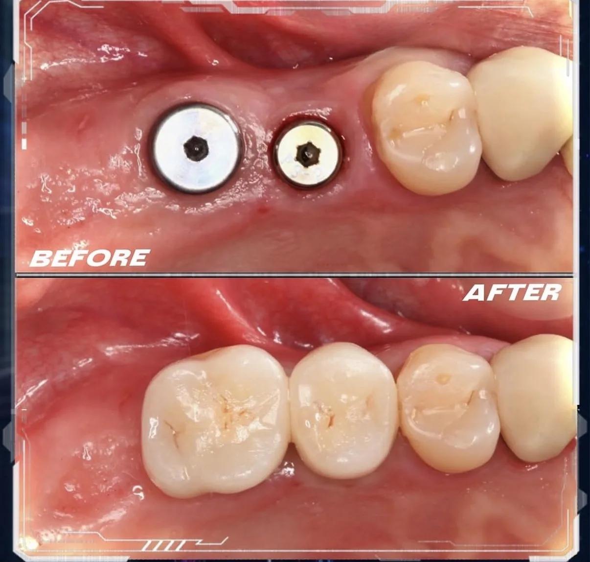 Dental implants