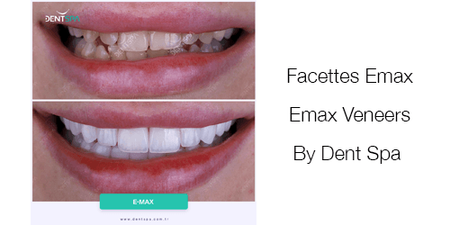 Facettes Emax