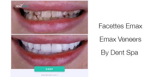 Faccette Emax