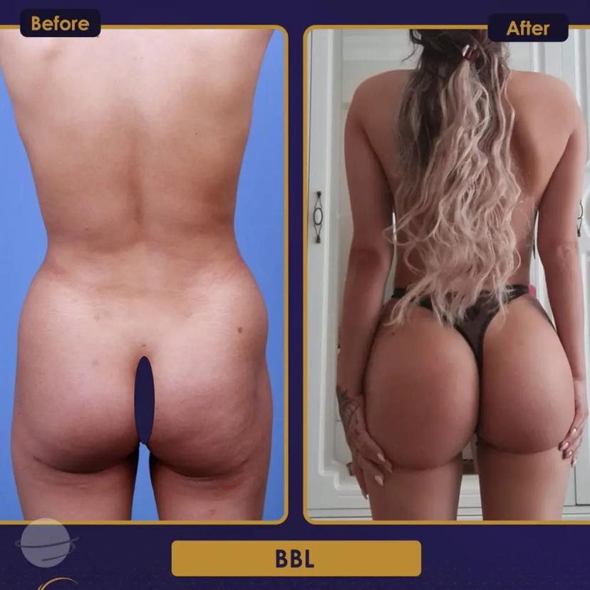 Buttocks lipofilling BBL