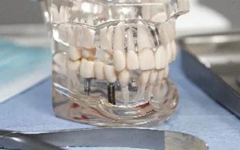 Implantes Straumann