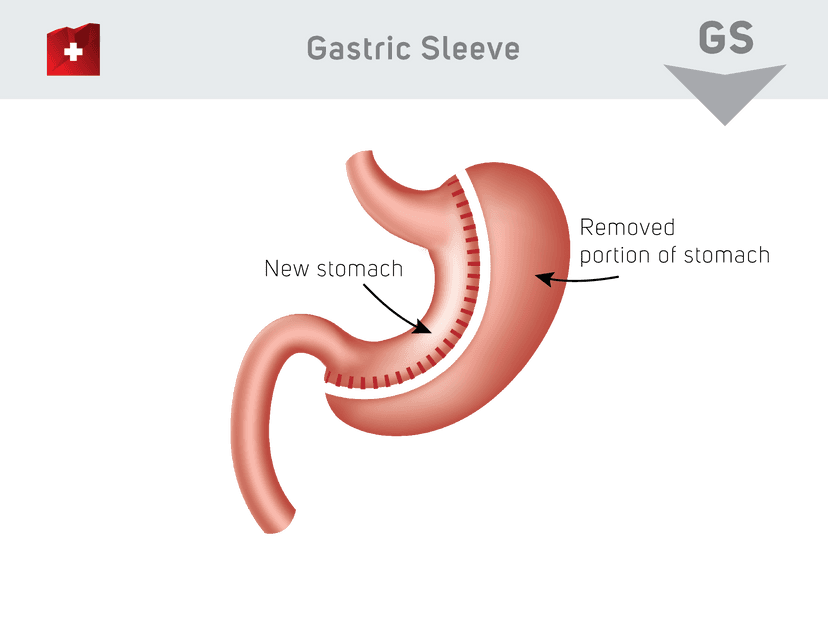 Sleeve gastrectomie