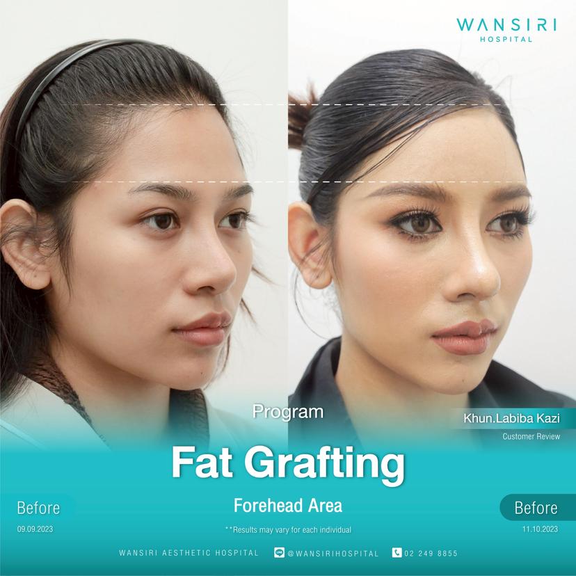 Lipofilling facciale