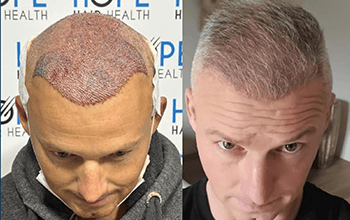 BHT Trapianto di capelli