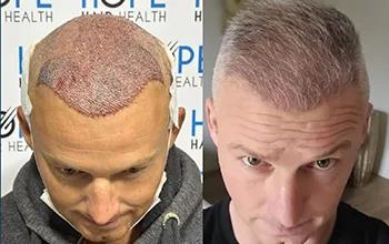 BHT Body Hair Transplant