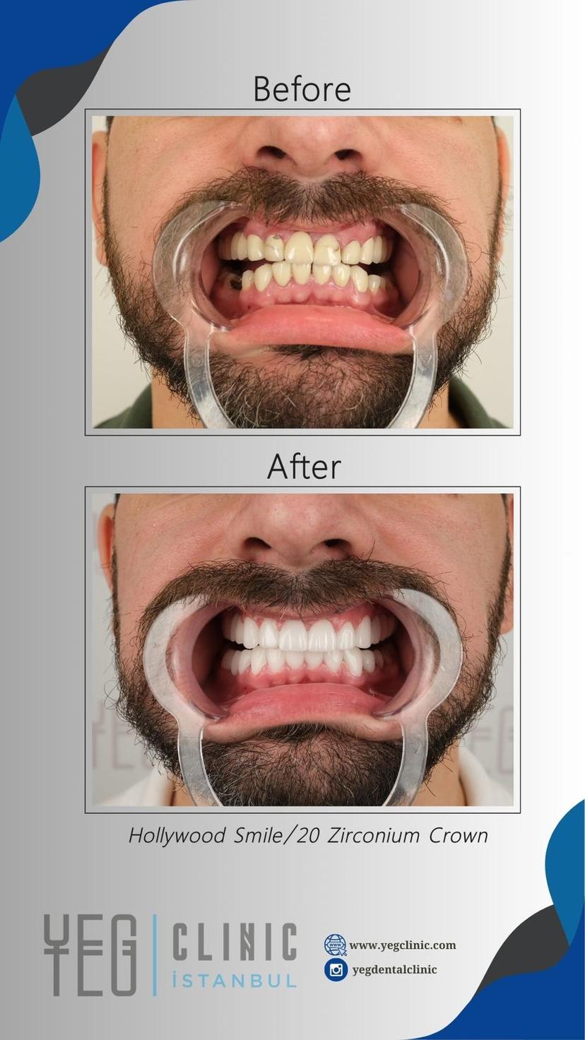 Total jaw reconstruction