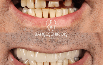 Reconstruction Totale