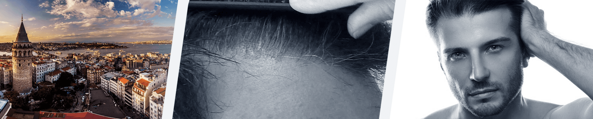 FUE Sapphire Hair Transplant Türkiye: Hair Implant Package banner